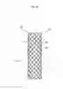 Fig. 08 - BIODEGRADABLE DOUBLE STENT