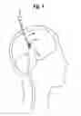 Fig. 05 - Methods and devices for treating obesity, incontinence, and neurological and physiological disorders