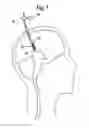Fig. 06 - Methods and devices for treating obesity, incontinence, and neurological and physiological disorders