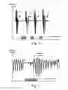 Fig. 04 - System for respiratory disorder therapy with selection of stimulation strategies