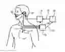 Fig. 01 - System for respiratory disorder therapy with stabilization control of stimulation