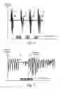 Fig. 04 - System for respiratory disorder therapy with stabilization control of stimulation