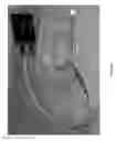 Fig. 07 - Device, system and method for facilitating breathing via simulation of limb movement