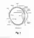 Fig. 02 - METHOD OF REDUCING INTRAOCULAR PRESSURE IN HUMANS
