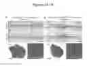 Fig. 02 - MODEL OF COLORECTAL CANCER