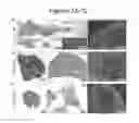 Fig. 16 - MODEL OF COLORECTAL CANCER