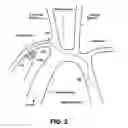 Fig. 04 - Skin interface device for cardiac assist device