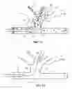 Fig. 09 - Device and methods for transvascular tumor embolization with integrated flow regulation