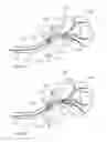 Fig. 35 - Device and methods for transvascular tumor embolization with integrated flow regulation