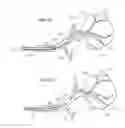Fig. 41 - Device and methods for transvascular tumor embolization with integrated flow regulation