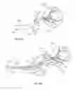 Fig. 43 - Device and methods for transvascular tumor embolization with integrated flow regulation
