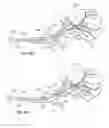 Fig. 44 - Device and methods for transvascular tumor embolization with integrated flow regulation