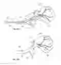 Fig. 45 - Device and methods for transvascular tumor embolization with integrated flow regulation