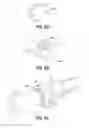 Fig. 06 - Syringe for and method of delivering a volume of solution with guidance bearing in view of standard and non-standard carpules