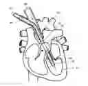 Fig. 01 - Self-expanding cannula