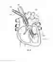 Fig. 11 - Self-expanding cannula