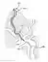 Fig. 01 - Anchor device for use with catheters