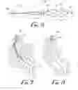 Fig. 04 - Anchor device for use with catheters