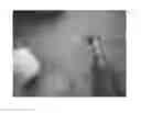 Fig. 01 - PERCUTANEOUS SCALPEL AND TISSUE DILATOR