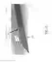Fig. 12 - ACTIVELY TRACKED MEDICAL DEVICES