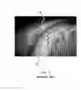 Fig. 04 - BALLOON CATHETER HAVING MICRO NEEDLES AND MANUFACTURING METHOD FOR THE SAME