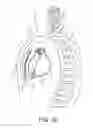 Fig. 03 - Over the needle implant tools and implant techniques utilizing such tools