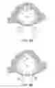 Fig. 04 - Electrode for common cavity cochlear malformation