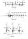 Fig. 04 - Vagus nerve stimulation method