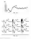 Fig. 05 - Vagus nerve stimulation method