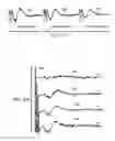 Fig. 06 - Vagus nerve stimulation method