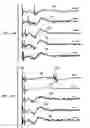 Fig. 07 - Vagus nerve stimulation method