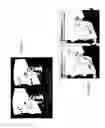 Fig. 15 - PERFORMANCE ENHANCING BITE REGULATOR AND SELF-IMPRESSION SYSTEM AND METHOD OF CUSTOM FITTING SAME