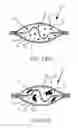 Fig. 08 - Device for facilitating a chemical reaction
