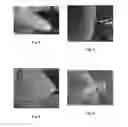Fig. 05 - Fluid injection nozzle for fluid bed reactors