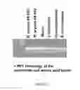 Fig. 08 - IMMUNOTHERAPY AND DIAGNOSIS OF MUCORMYCOSIS USING COTH