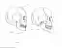 Fig. 02 - Determination of the position of the condylar articulation axis for creating a virtual articulator