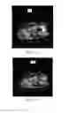 Fig. 03 - Processing metal artifact in CT image