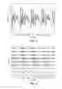 Fig. 04 - Hearing implant bilateral matching of ILD based on measured ITD