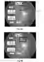 Fig. 07 - Quantifying a blood vessel reflection parameter of the retina