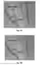 Fig. 08 - Quantifying a blood vessel reflection parameter of the retina
