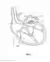 Fig. 14 - Atrial fibrillation treatment systems and methods