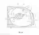 Fig. 15 - Atrial fibrillation treatment systems and methods