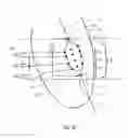 Fig. 17 - Atrial fibrillation treatment systems and methods