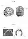 Fig. 04 - MAGNETIC RESONANCE IMAGING TOOL TO DETECT CLINICAL DIFFERENCE IN BRAIN ANATOMY