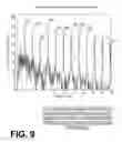 Fig. 07 - Filtering patient signal also for ventilation artifacts