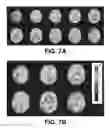 Fig. 11 - ViRPET—combination of virtual reality and PET brain imaging