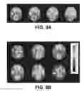Fig. 13 - ViRPET—combination of virtual reality and PET brain imaging
