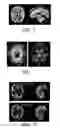 Fig. 02 - Method for analyzing and correcting measurement variability in PET images
