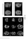 Fig. 09 - Method for analyzing and correcting measurement variability in PET images