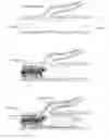 Fig. 01 - Embolisation systems